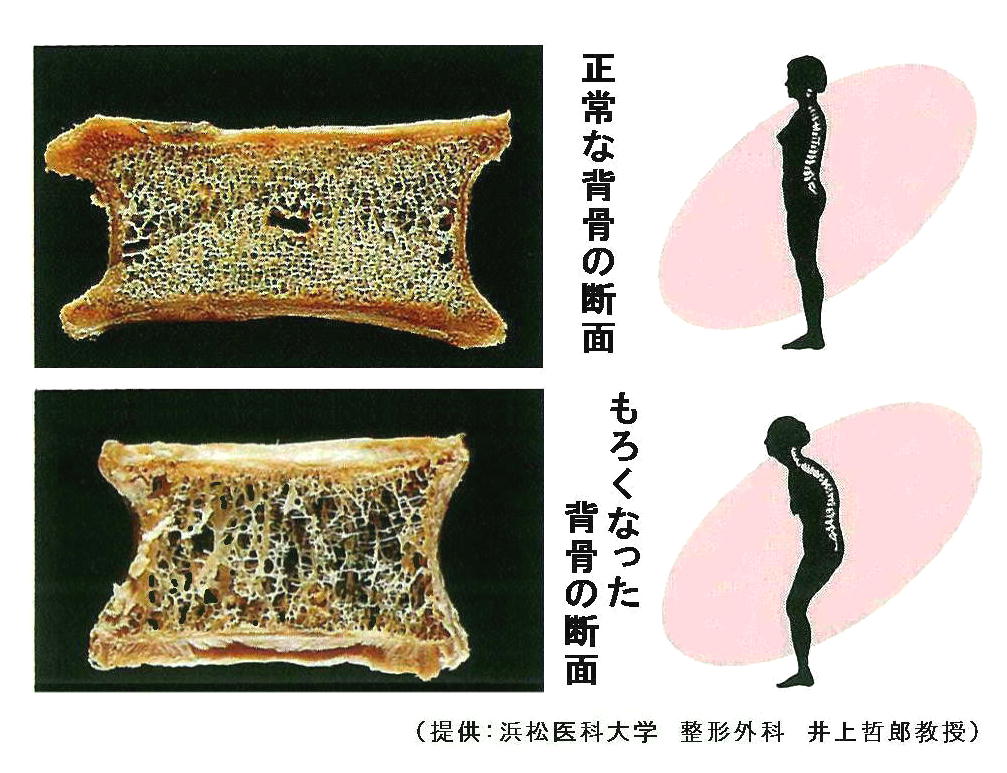 食事が骨の健康に与える影響